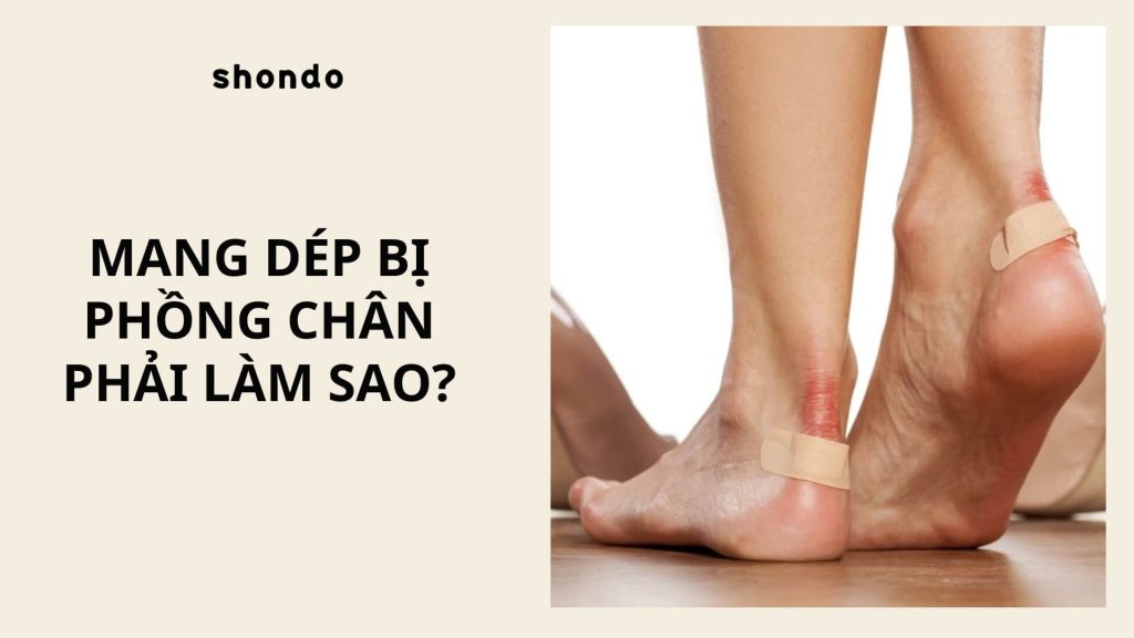 mang dép bị phồng chân