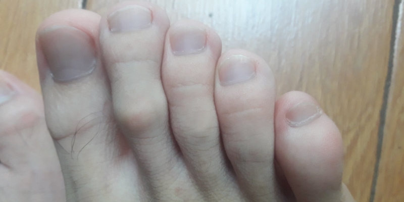 The shoe material is too hard, causing the little toe to swell.